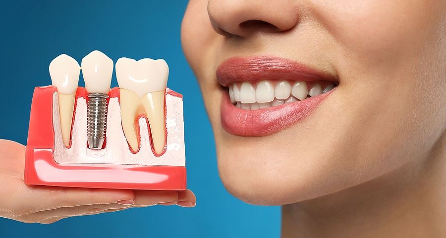 5 Reasons Dental Implants May Be Necessary