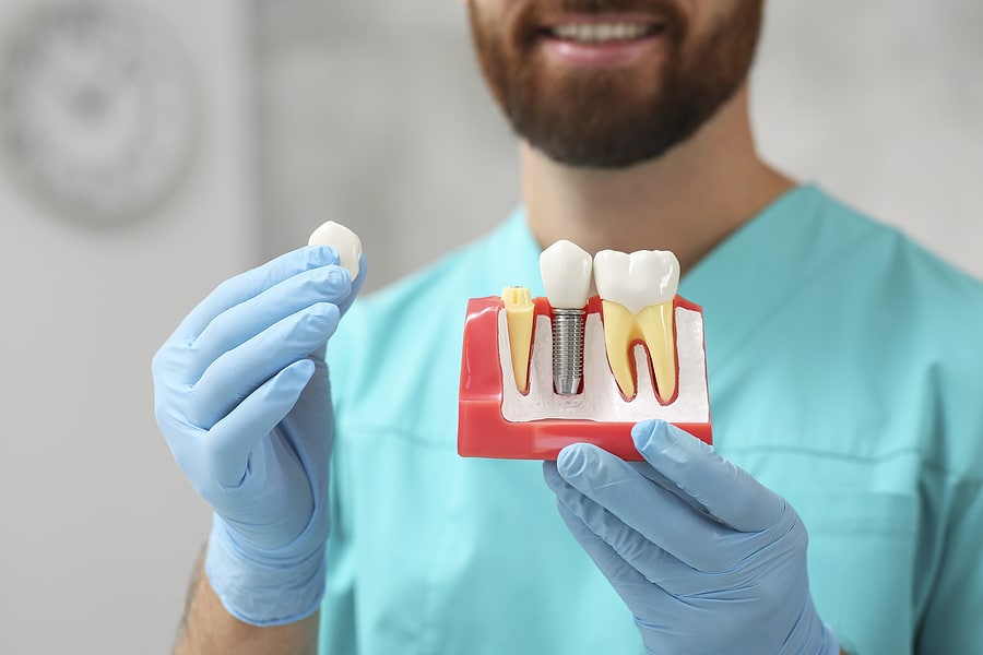 6 Benefits of a Fixed Dental Bridge