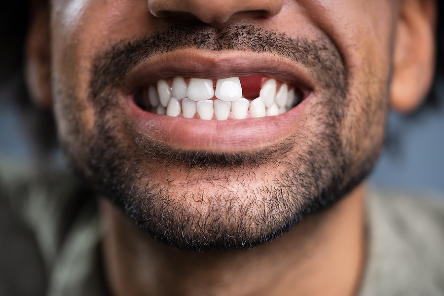 Missing a Tooth? Here’s Why You Shouldn’t Wait to Replace It